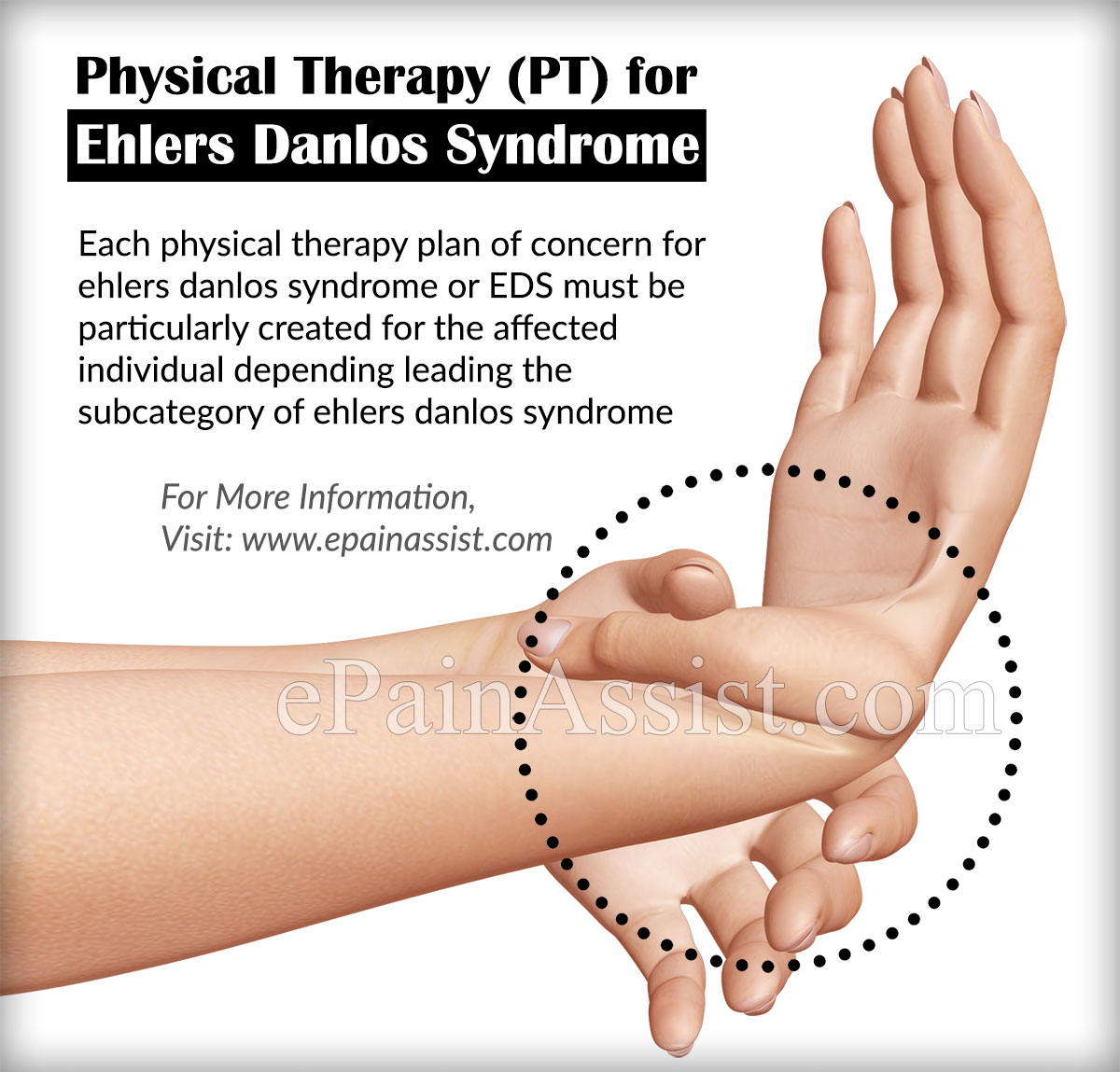 Physical Therapy (PT) for Ehlers Danlos Syndrome or EDS