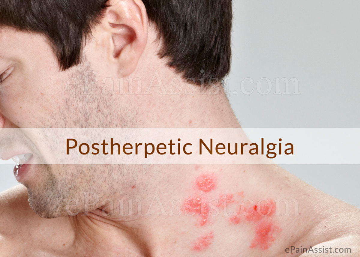 Postherpetic Neuralgia: Causes, Risk Factors, Signs, Symptoms, Treatment, Investigations