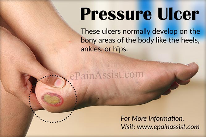 Pressure Ulcer or Bed Sores