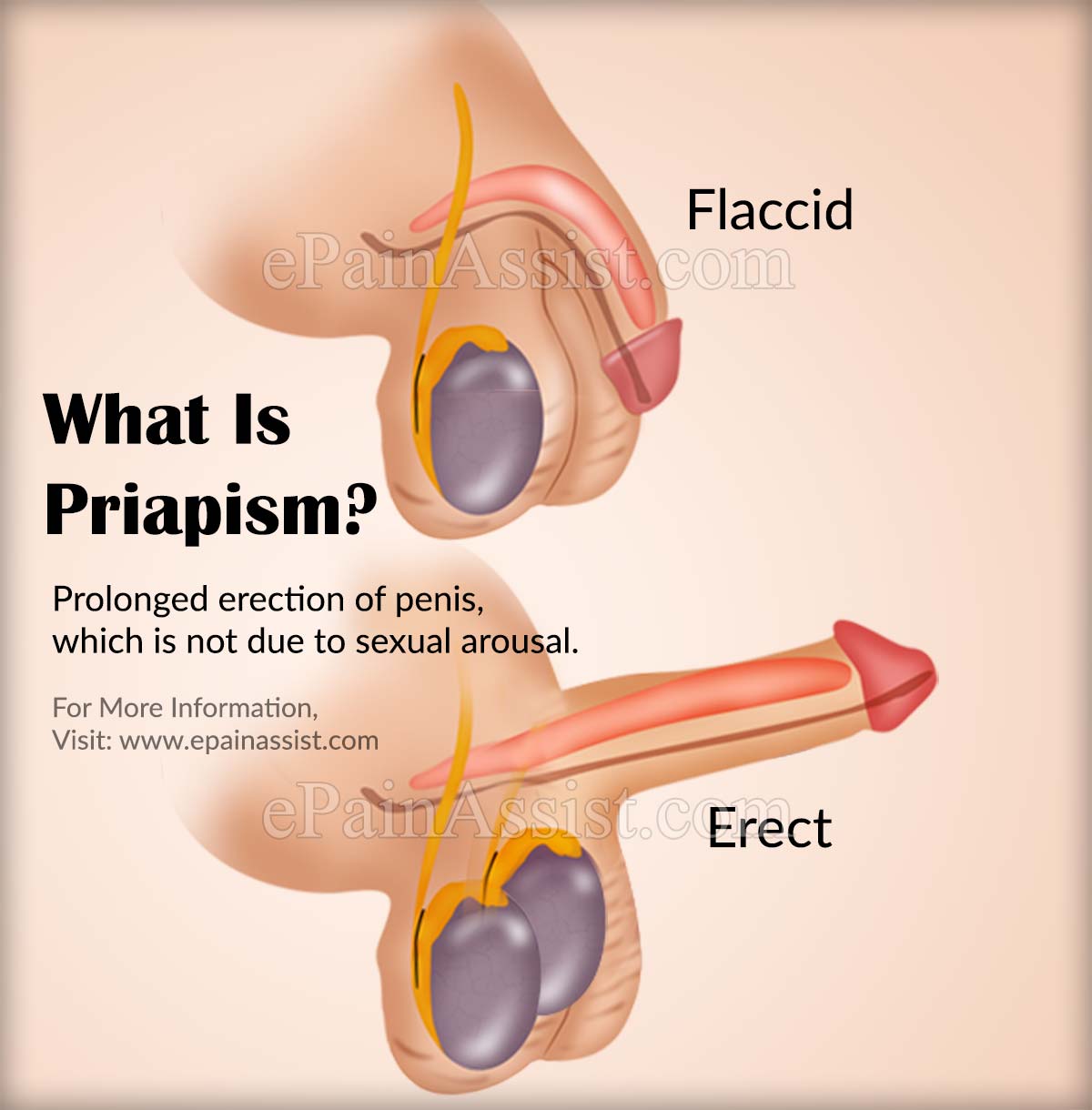 What Is Priapism?