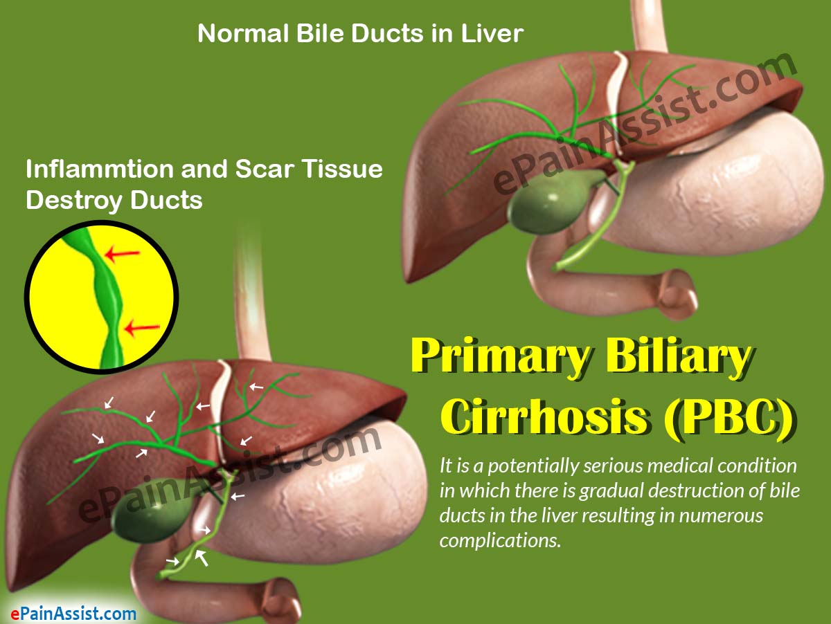Primary Biliary Cirrhosis (PBC)