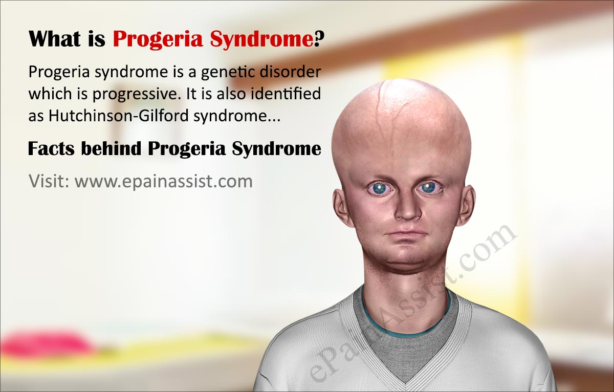 Progeria Aging Chart