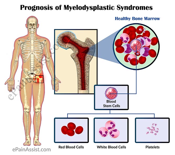 Prognosis of Myelodysplastic Syndromes or MDS