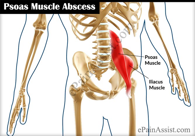 Psoas Muscle Abscess