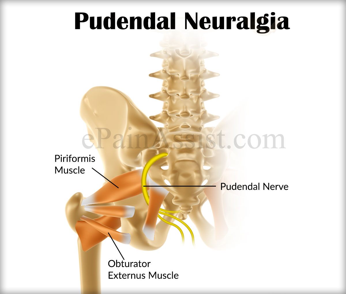 Pudendal Neuralgia