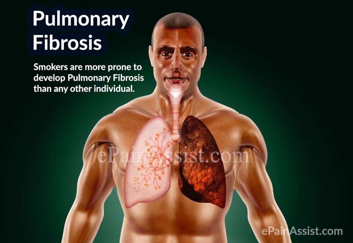 Pulmonary Fibrosis