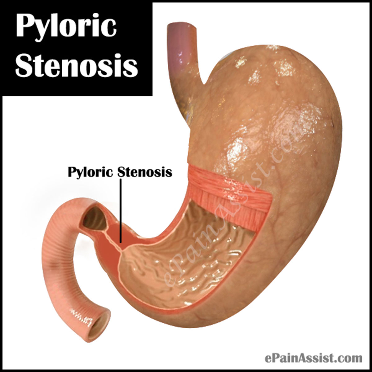 Pyloric Stenosis or Pylorostenosis