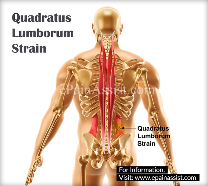 Quadratus Lumborum Strain