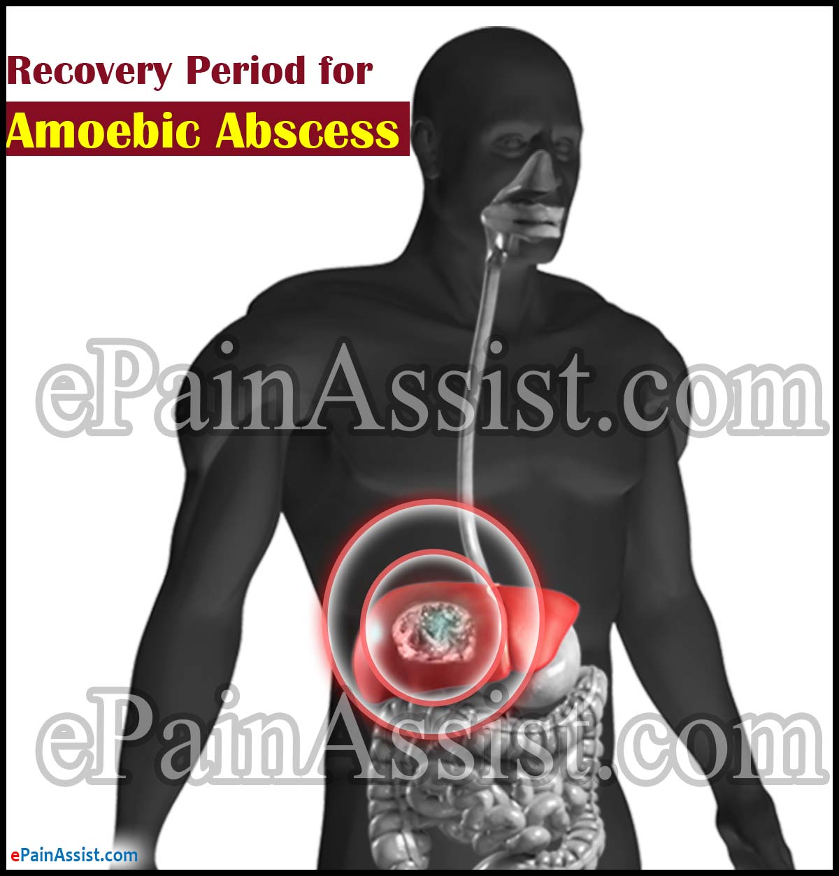 Recovery Period for Amoebic Abscess or Amoebic Liver Abscess