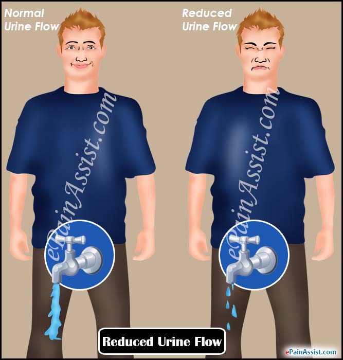 What Can Cause Reduced Urine Flow?