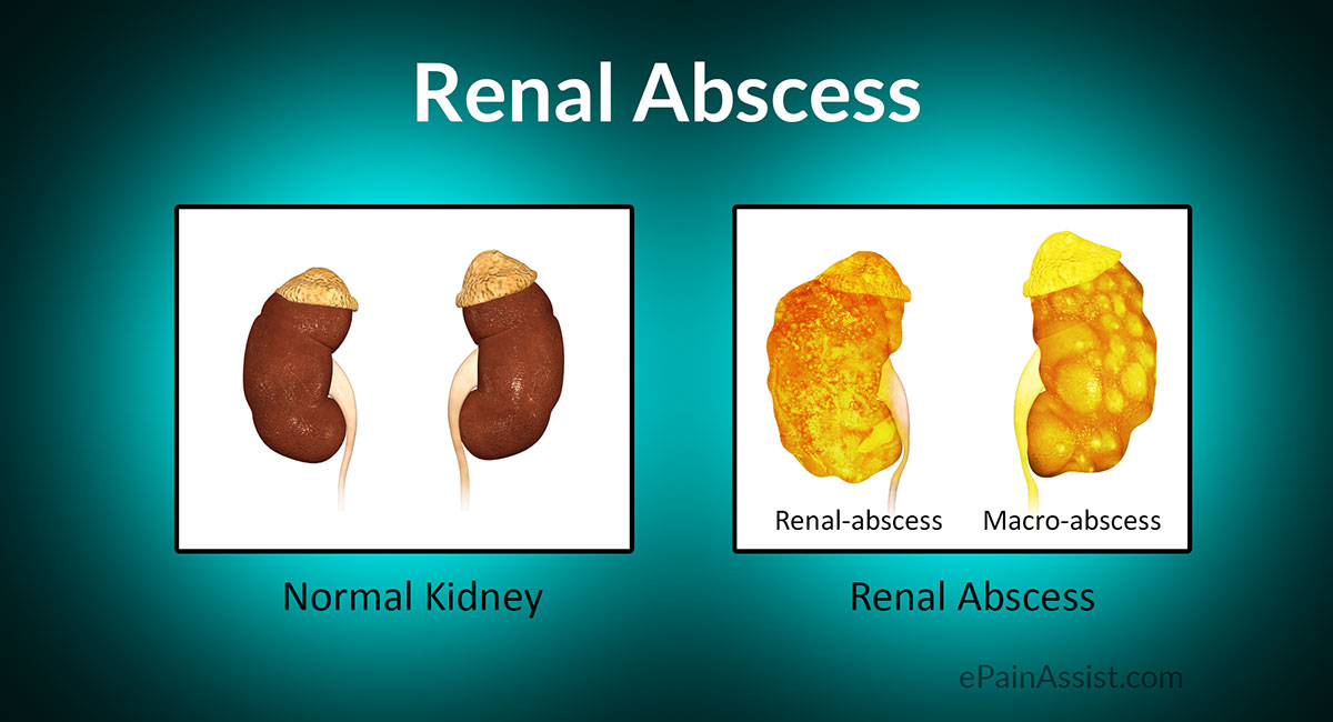 What are the initial signs of a kidney infection?