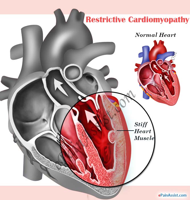 Restrictive Cardiomyopathy