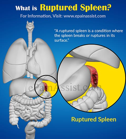 What is Ruptured Spleen? What is Ruptured Spleen?