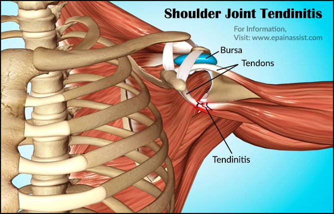 What is Shoulder Joint Tendinitis