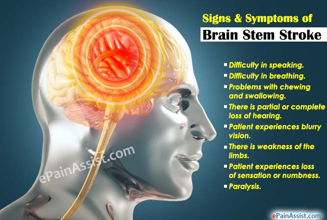 Signs & Symptoms of Brain Stem Stroke