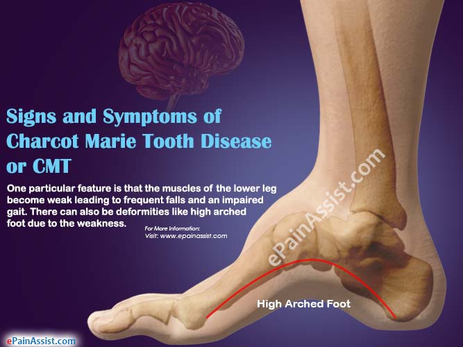 Charcot Marie Tooth Disease or CMT