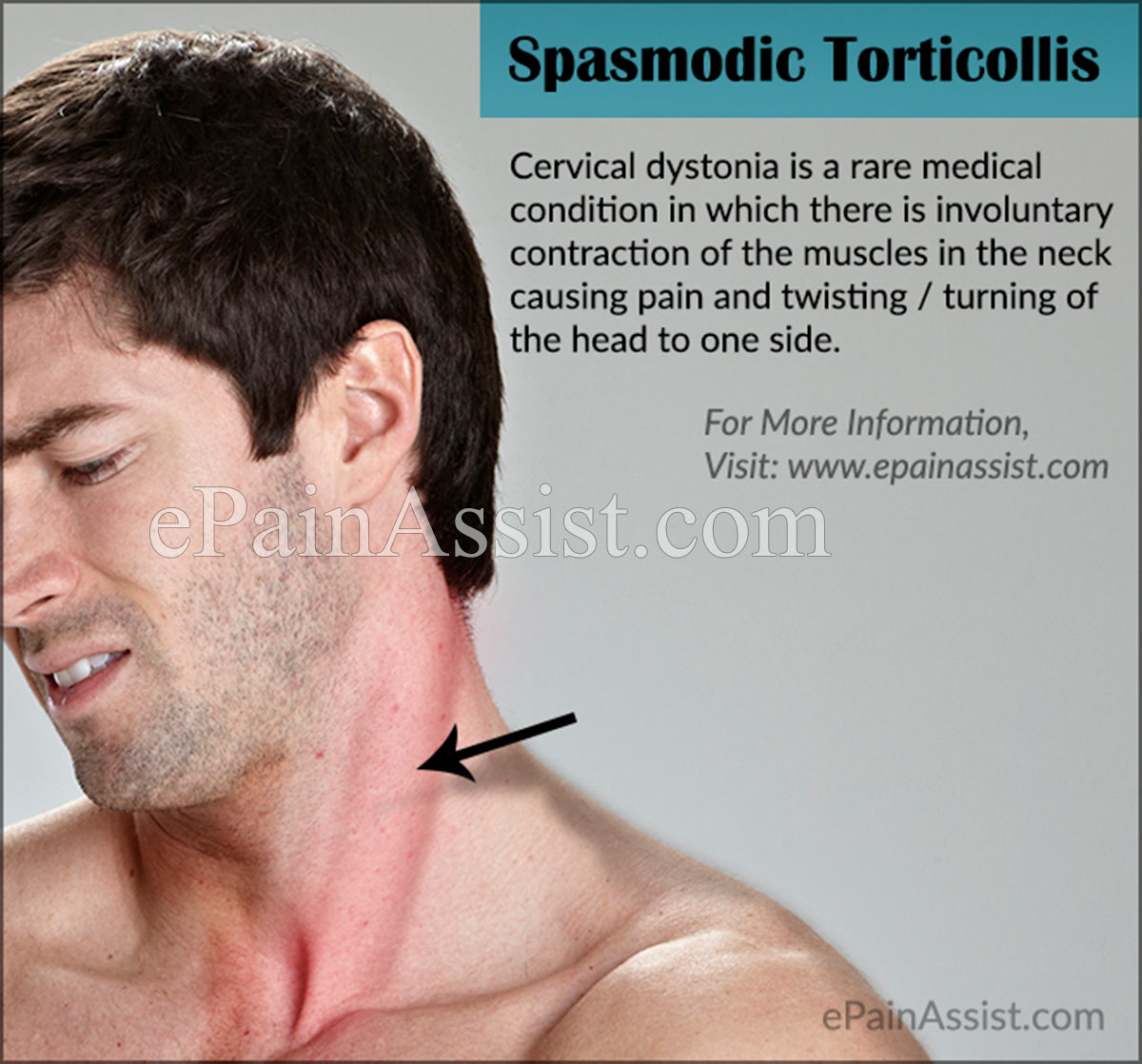 Spasmodic Torticollis Spasmodic Torticollis