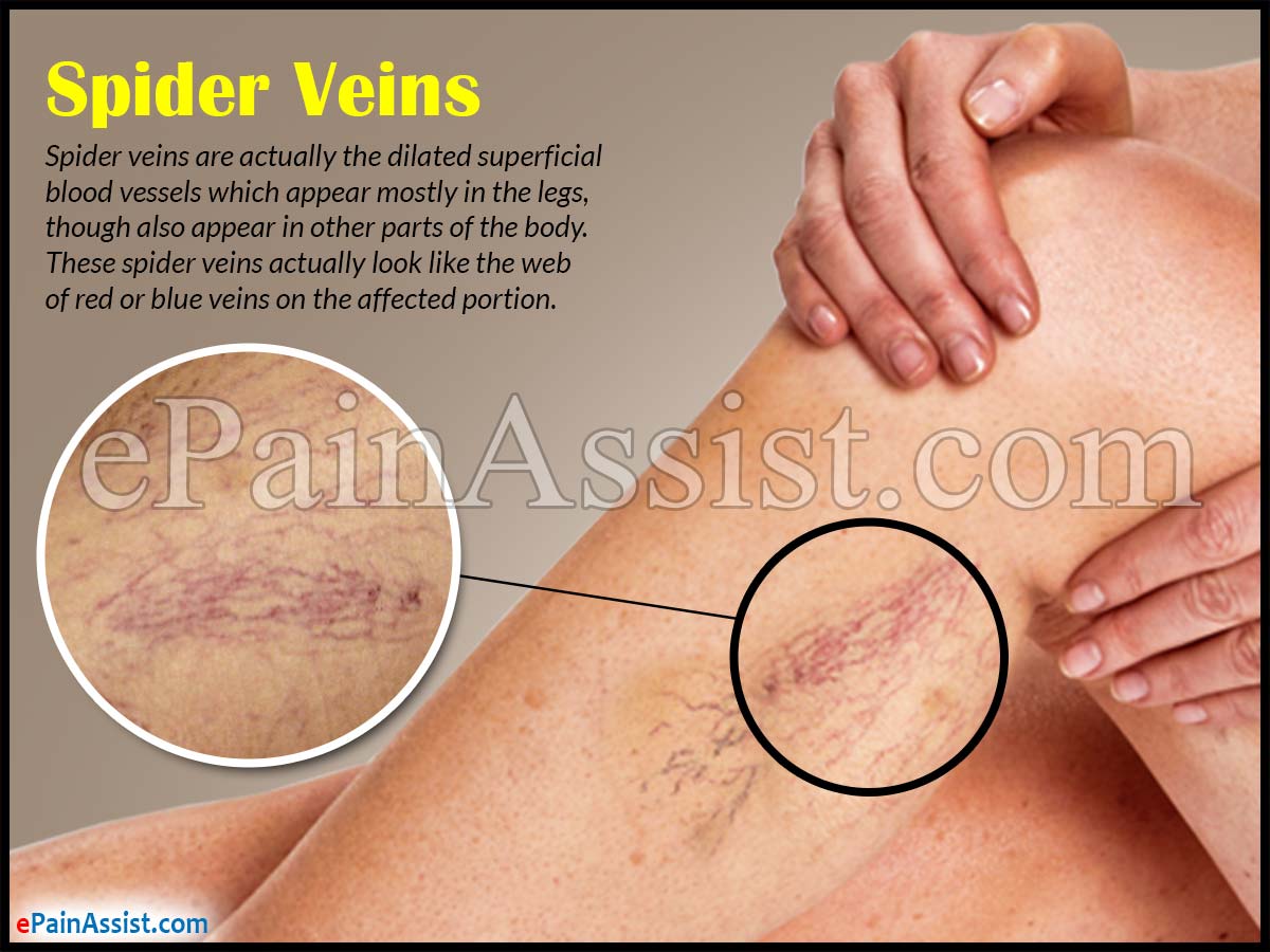 Spider Veins Spider Veins