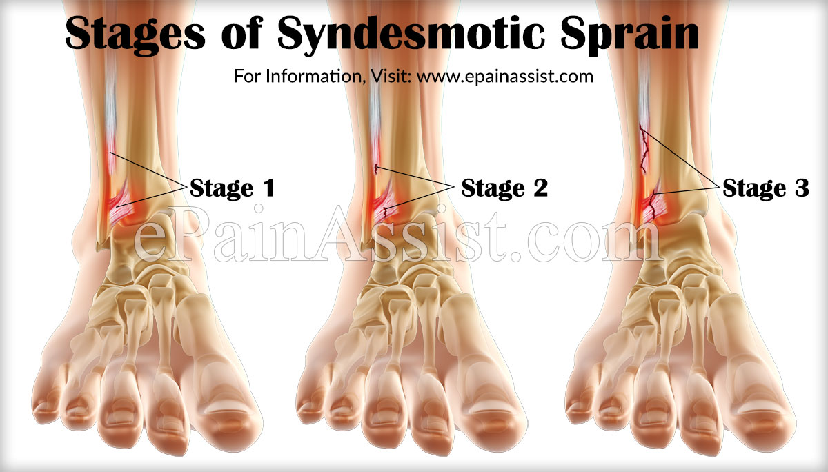 Syndesmotic Sprain Or Syndesmotic Ankle Sprain Causes Symptoms Syndesmotic Sprain Or Syndesmotic Ankle Sprain Causes Symptoms