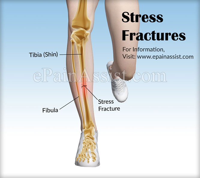 Stress Fractures