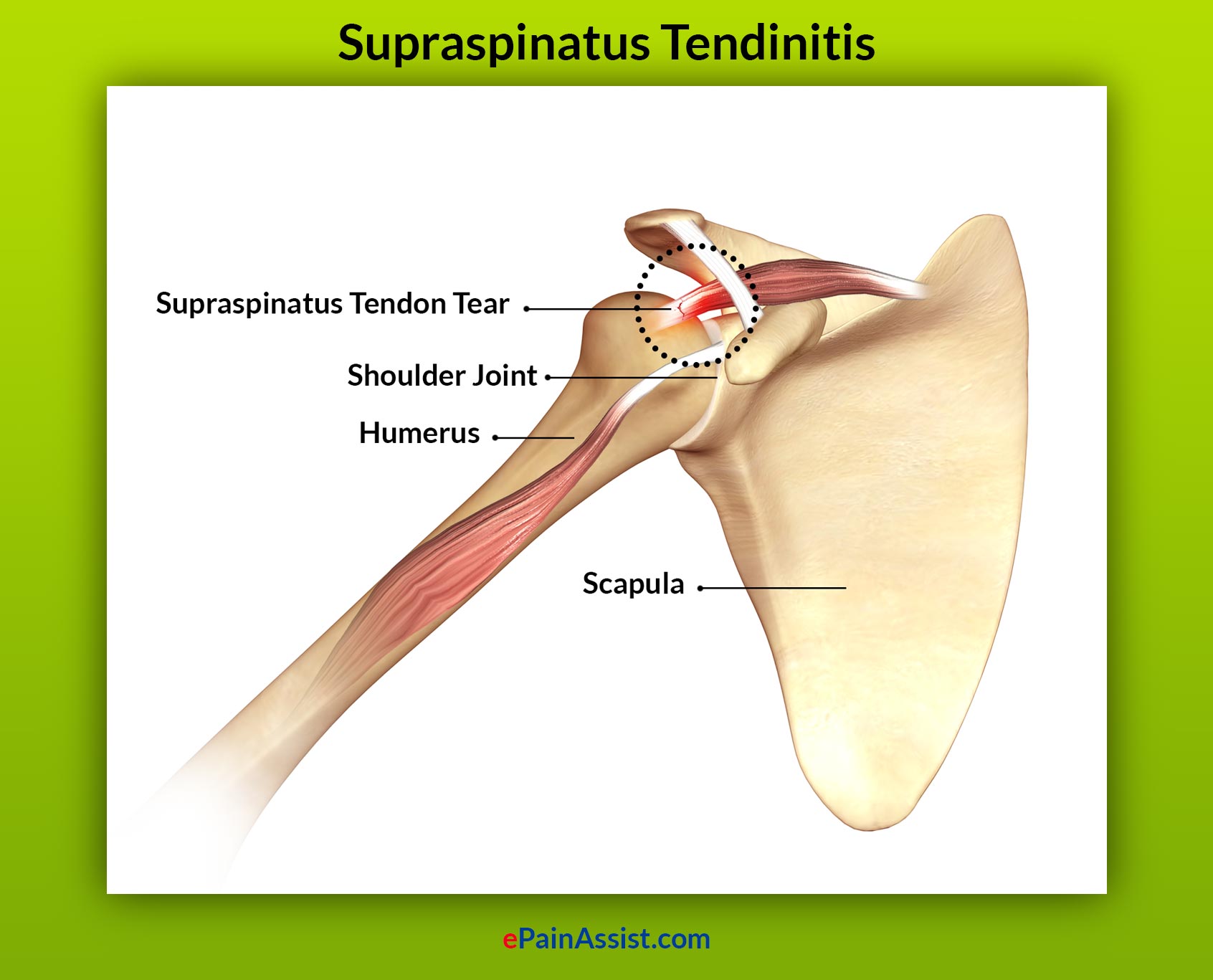 Supraspinatus Tendinitis: Treatment, Causes, Symptoms, Prognosis