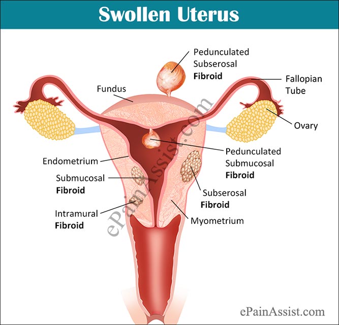 Swollen Uterus or Enlarged Uterus