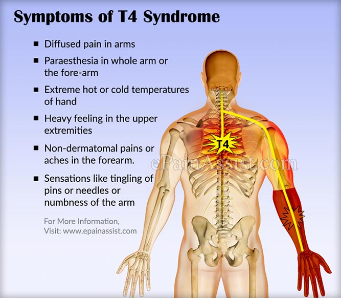 T4 Syndrome|Signs|Symptoms|Causes|Treatment|Recovery