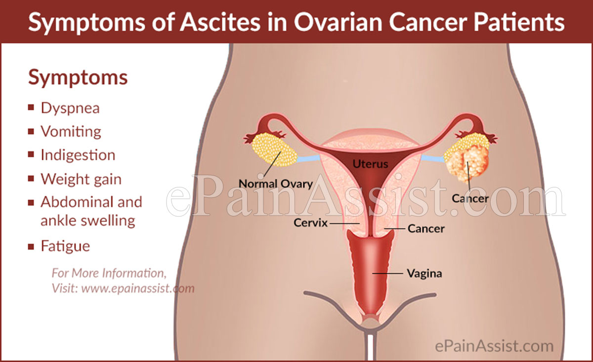 Signs and Symptoms of Ascites in Ovarian Cancer Patients