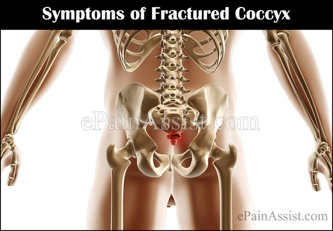 What are the Symptoms of Fractured Coccyx?