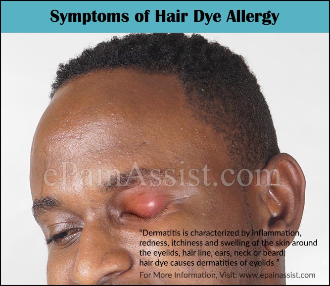 Symptoms of Hair Dye Allergy