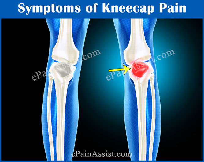 Symptoms of Kneecap Pain