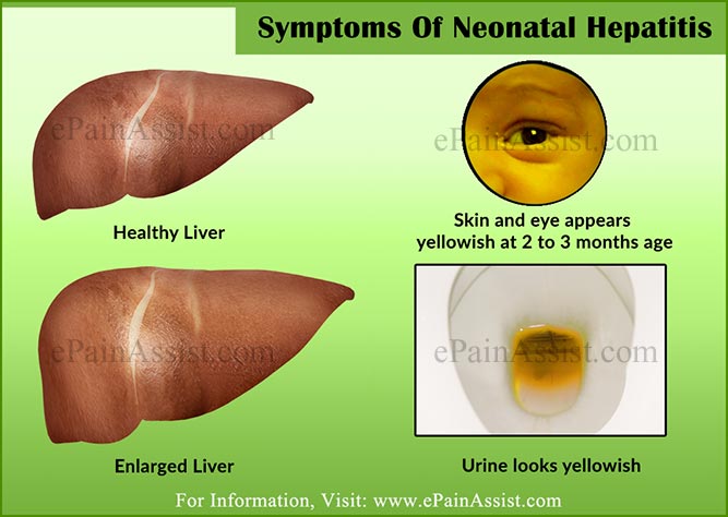 Symptoms Of Neonatal Hepatitis