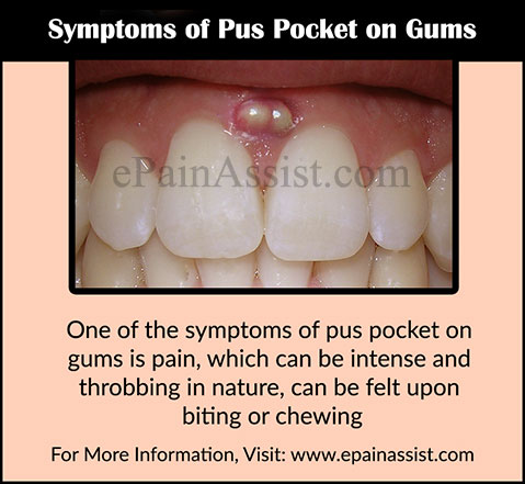 Signs and Symptoms of Pus Pocket on Gums