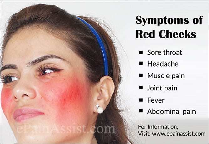 Symptoms of Red Cheeks or Slapped Cheek Disease in Adults