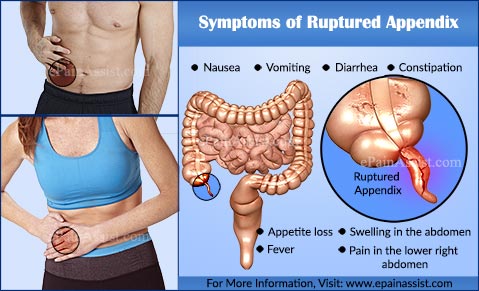 Symptoms of Ruptured Appendix