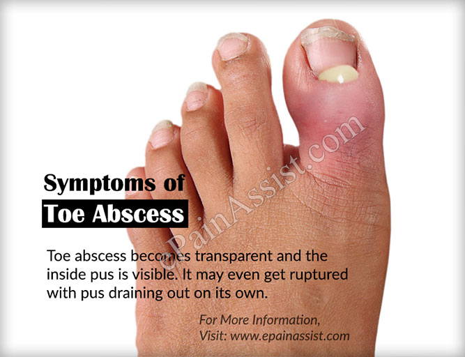 Signs and Symptoms of Toe Abscess Signs and Symptoms of Toe Abscess