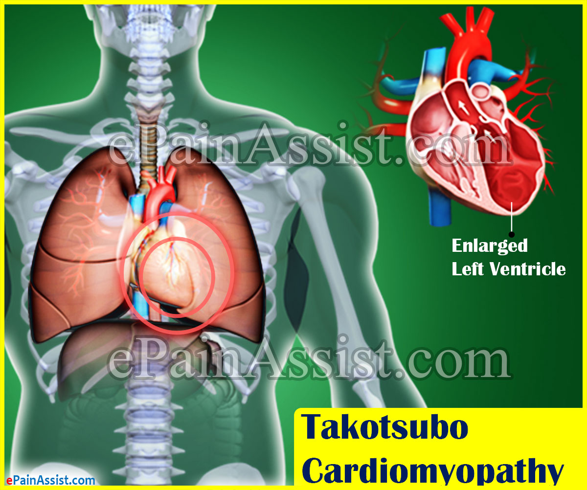 Takotsubo Cardiomyopathy or Broken Heart Syndrome