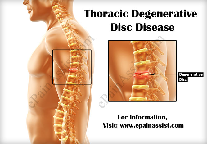 Thoracic Degenerative Disc Disease