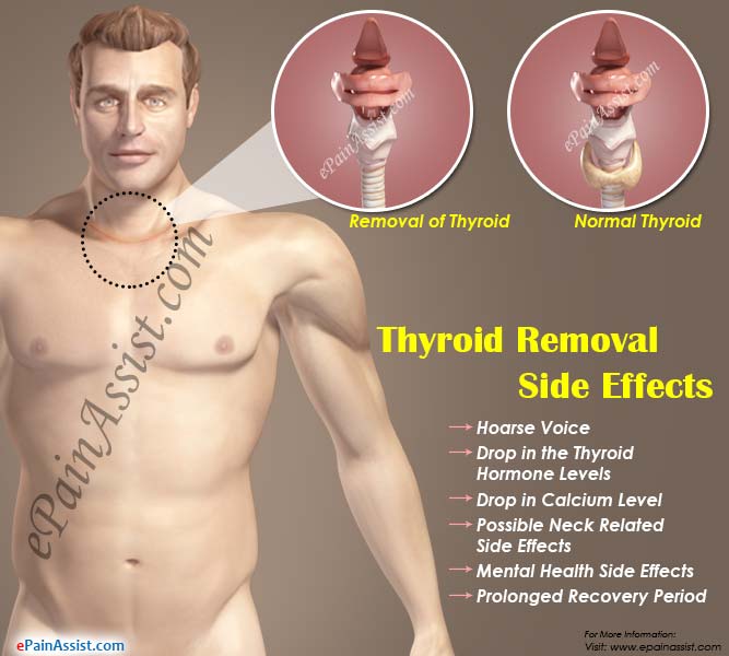 Thyroid Removal Side Effects