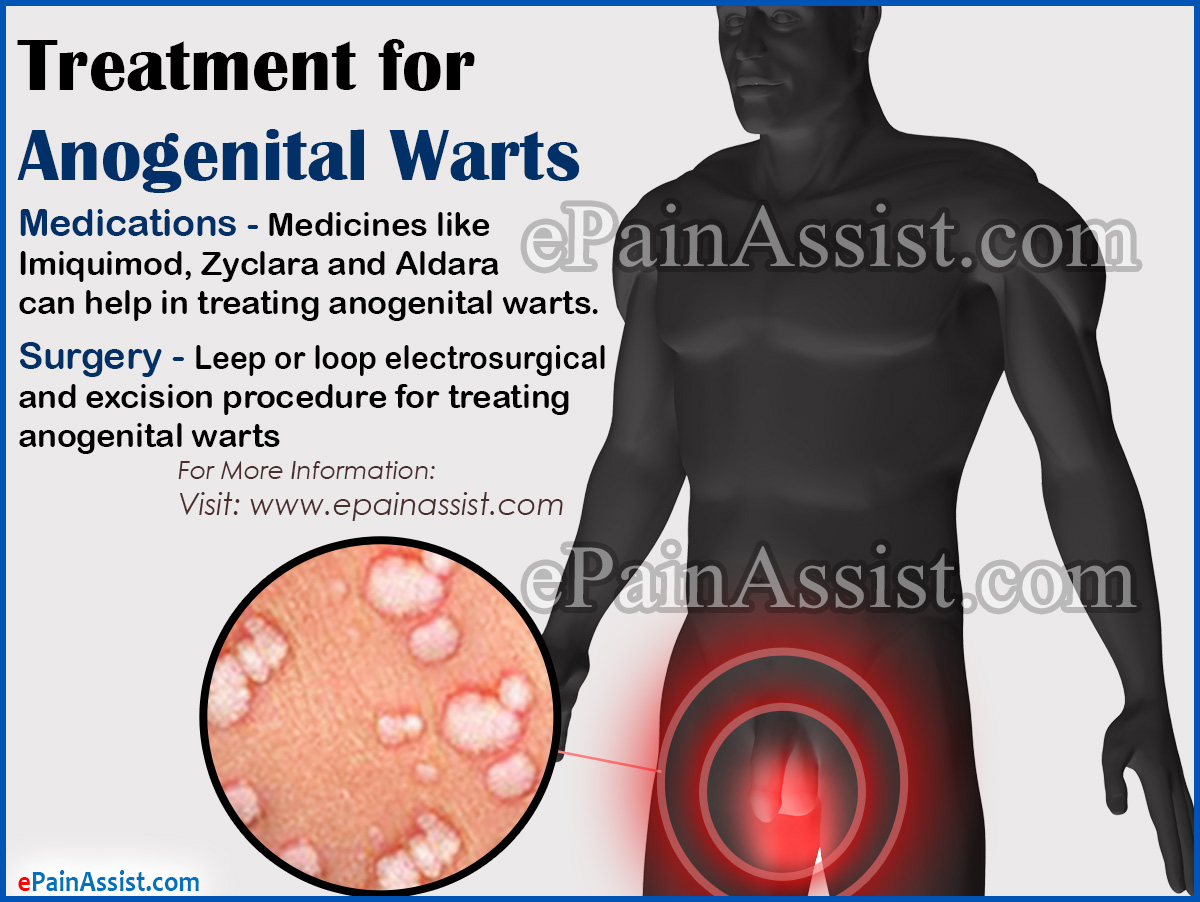 Treatment for Anogenital Warts Treatment for Anogenital Warts