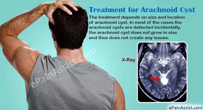 Treatment for Arachnoid Cyst