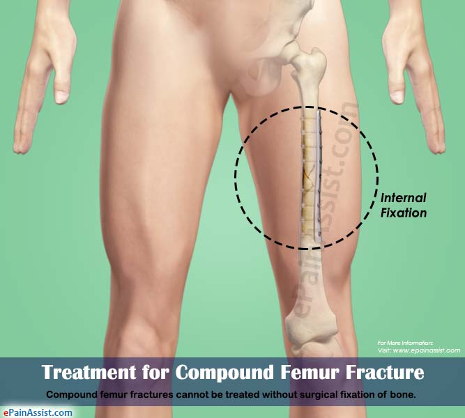 Treatment for Compound Femur Fracture