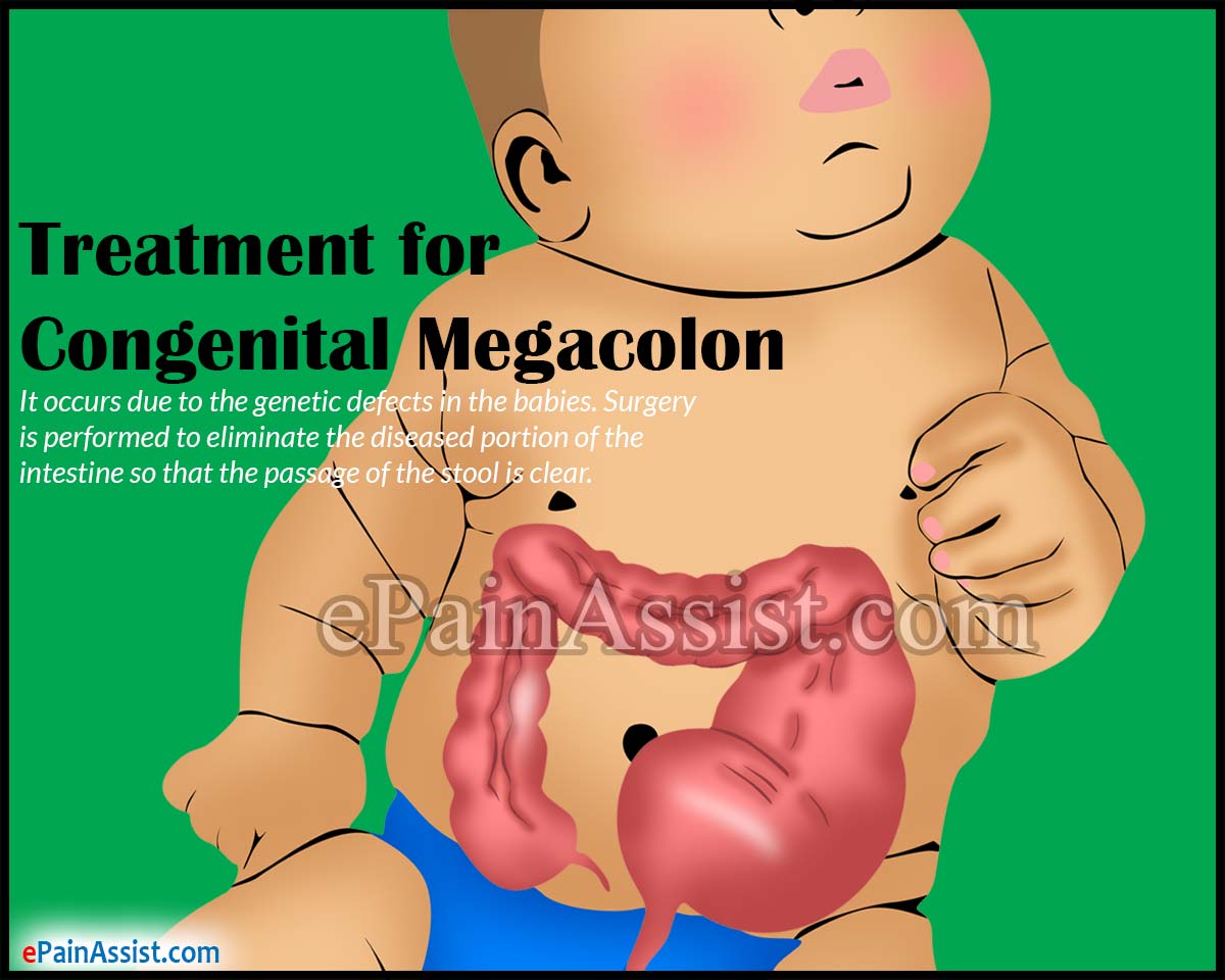 Treatment for Congenital Megacolon or Congenital Aganglionic Megacolon Treatment for Congenital Megacolon or Congenital Aganglionic Megacolon