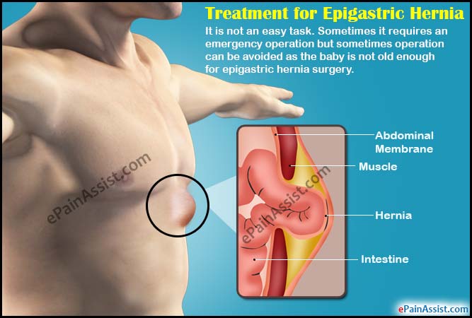 Treatment for Epigastric Hernia