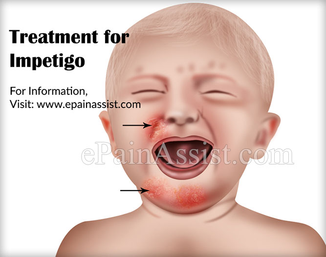 Treatment for Impetigo