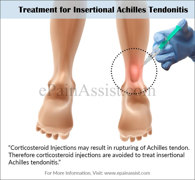 Treatment for Insertional Achilles Tendonitis