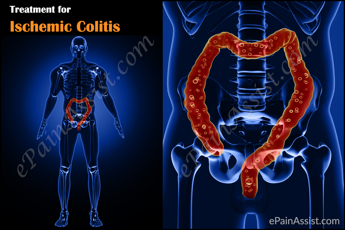 Ischemic Colitis Treatment Ischemic Colitis Treatment