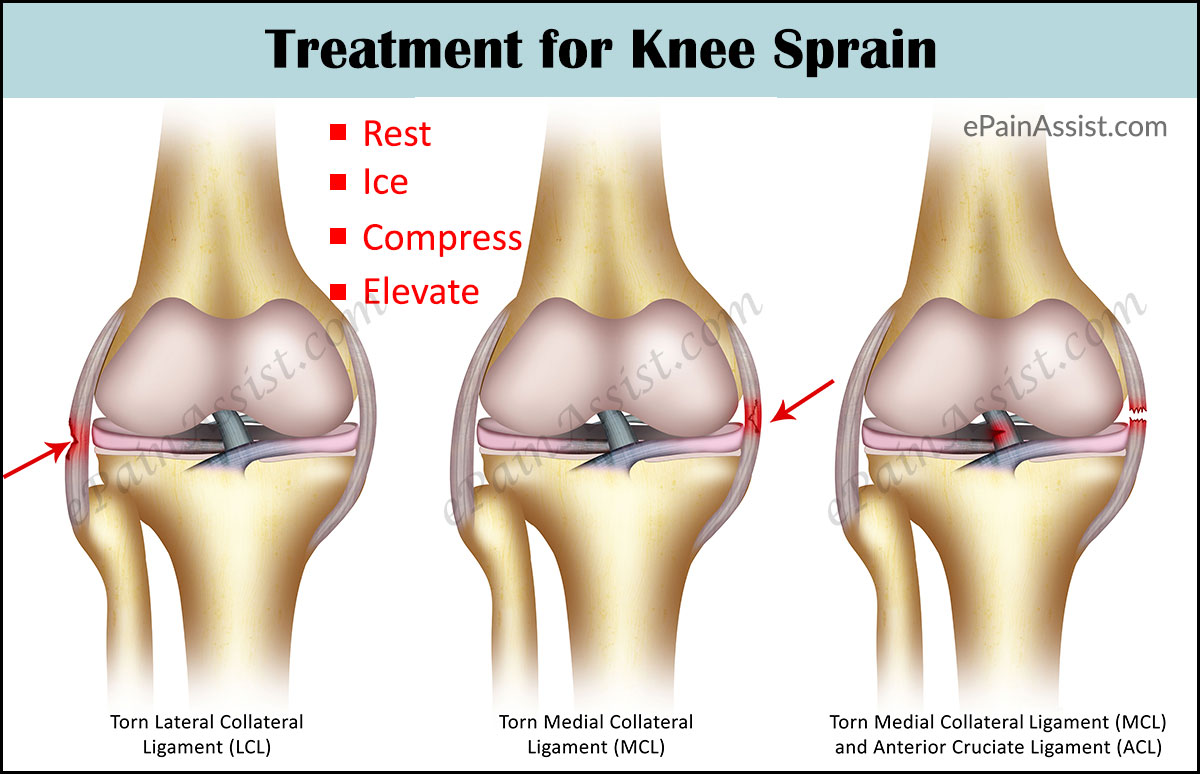 Treatment for Knee Sprain Treatment for Knee Sprain