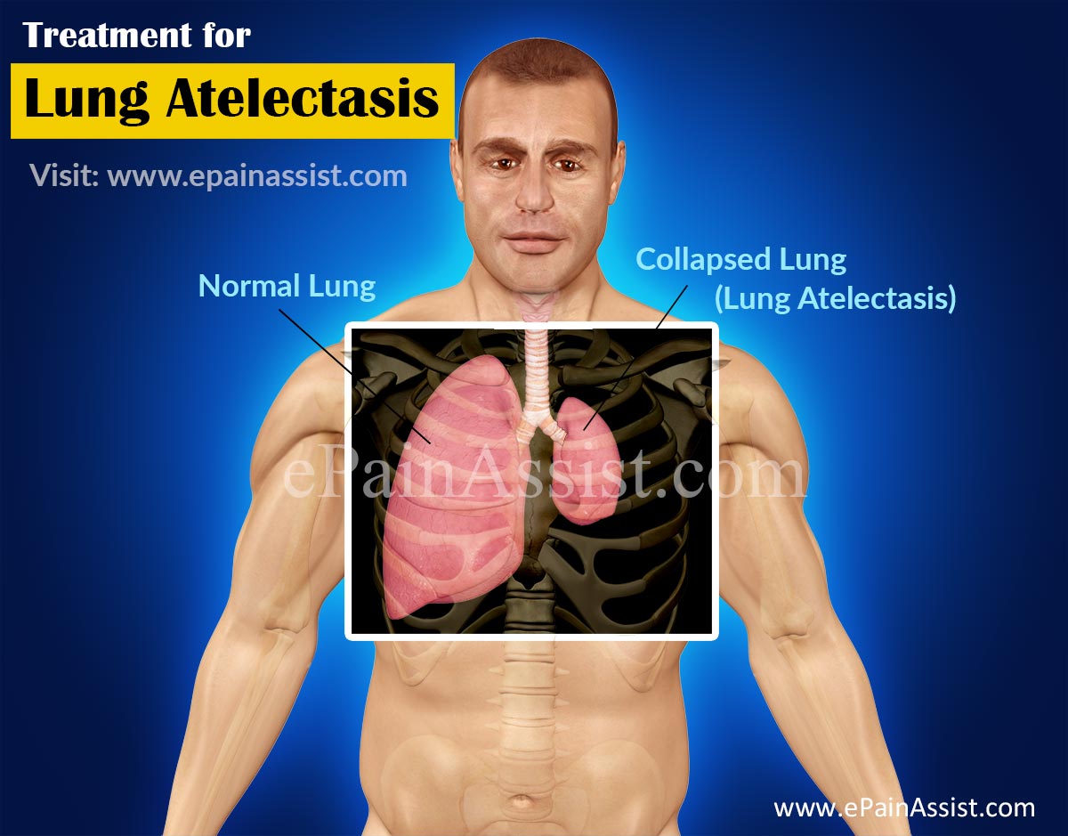 Treatment for Lung Atelectasis