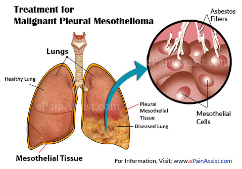 Malignant Pleural Mesothelioma|Treatment|Alternative & Complementary